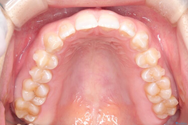 前歯の隙間を閉じたい　インビザラインによる矯正 治療途中画像
