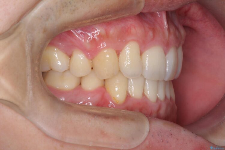 前歯のガタガタをきれいにしたい　ワイヤーによる抜歯矯正で整った歯並びへ 治療後画像
