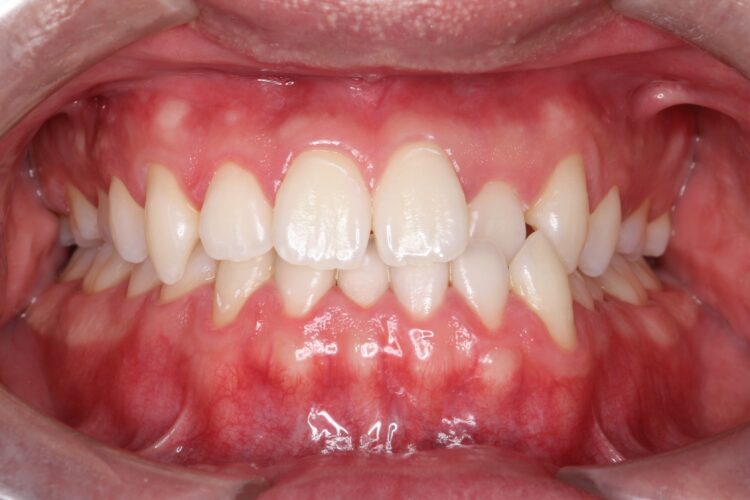 オフィスホワイトニングで明るく白い歯に！ 治療後画像
