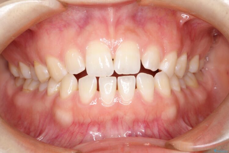 前歯の隙間を閉じたい　インビザラインによる矯正 ビフォー