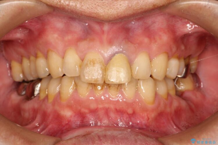 前歯が折れていた　インプラントによる審美的・機能的回復 治療前画像