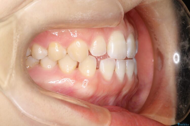 前歯の隙間を閉じたい　インビザラインによる矯正 治療前画像