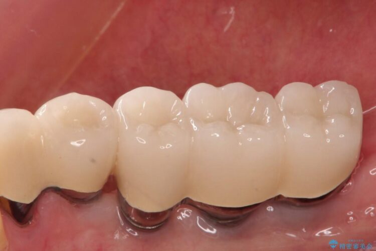 奥歯で咬むことができない　インプラントとセラミックによる咬み合わせの回復 治療後画像