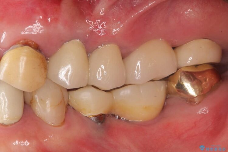 部分矯正で歯を正しい位置に移動しインプラント治療を行った症例 アフター