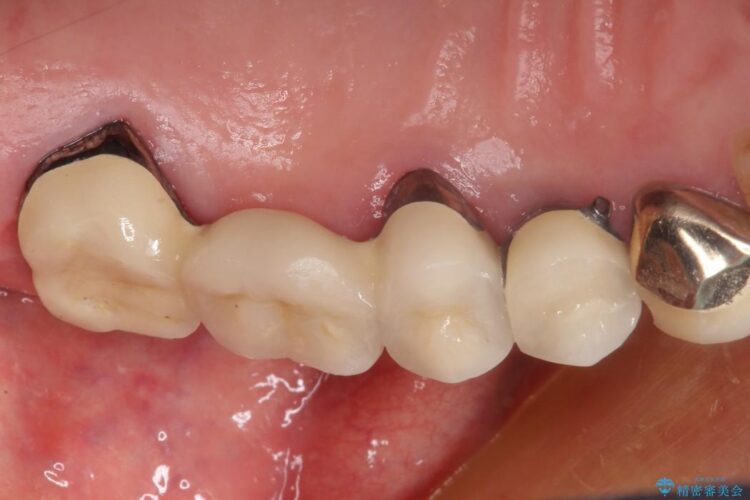 部分矯正で歯を正しい位置に移動しインプラント治療を行った症例 治療後画像