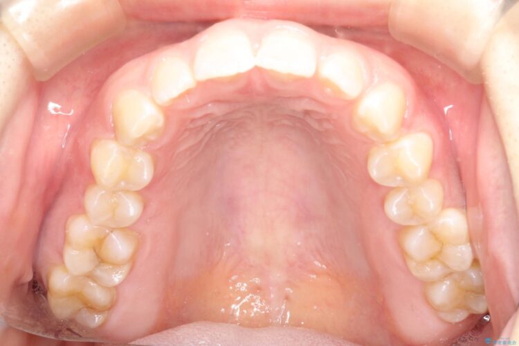 前歯の隙間を閉じたい　インビザラインによる矯正 治療前画像