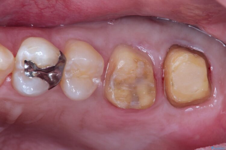 金歯が目立つ　自然な色のオールセラミックへ 治療途中画像