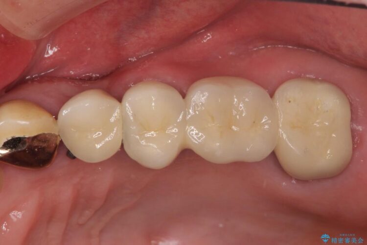 部分矯正で歯を正しい位置に移動しインプラント治療を行った症例 治療後画像