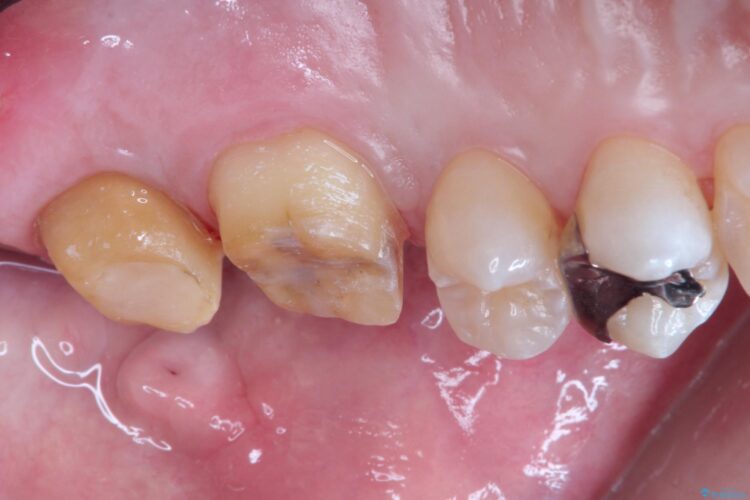 金歯が目立つ　自然な色のオールセラミックへ 治療途中画像