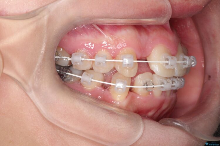 犬歯が変な位置にある　抜歯矯正により正しい位置へ 治療途中画像