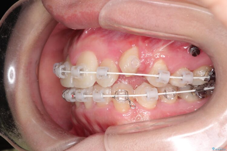 犬歯が変な位置にある　抜歯矯正により正しい位置へ 治療途中画像