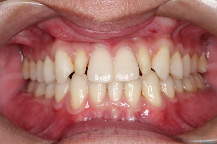矮小歯(通常より小さな歯)をオールセラミックへ　自然な見た目に 治療途中画像