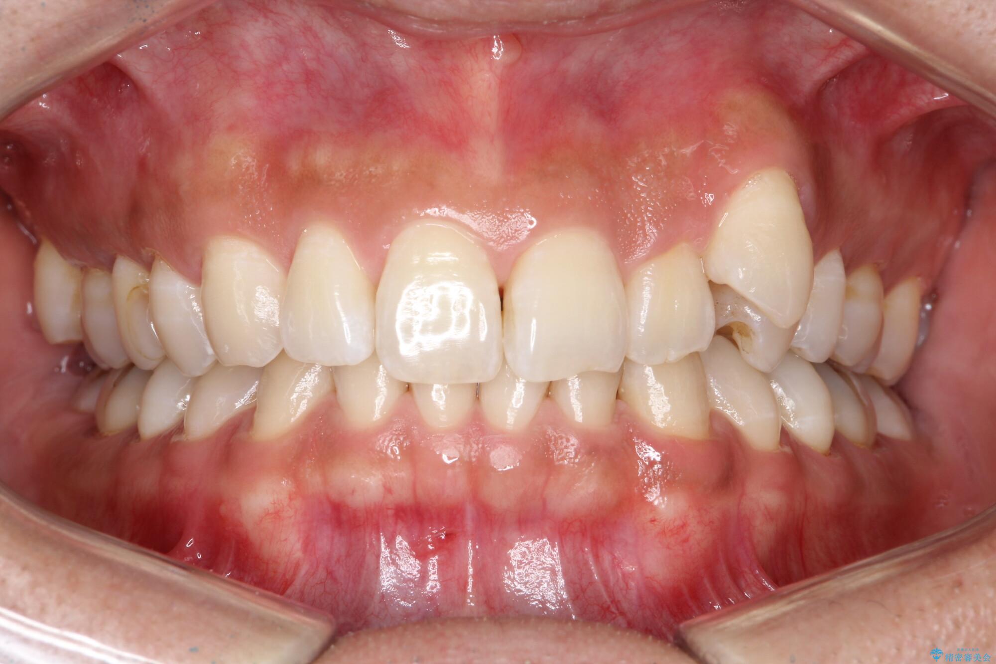 八重歯をインビザラインで矯正　成人の目立たない矯正 治療前