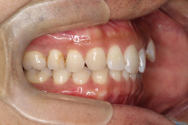 八重歯をインビザラインで矯正　成人の目立たない矯正 治療前画像