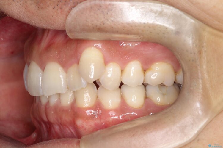 八重歯をインビザラインで矯正　成人の目立たない矯正 治療前画像