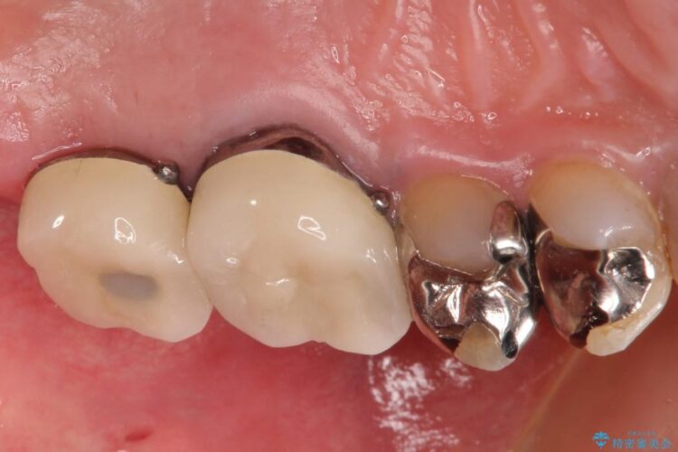根管治療とインプラント治療で奥歯でしっかりと咬めるように 治療後画像