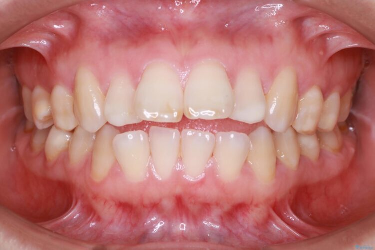 歯が前に出てて、口が閉じない　抜歯矯正による口元の改善 治療前画像