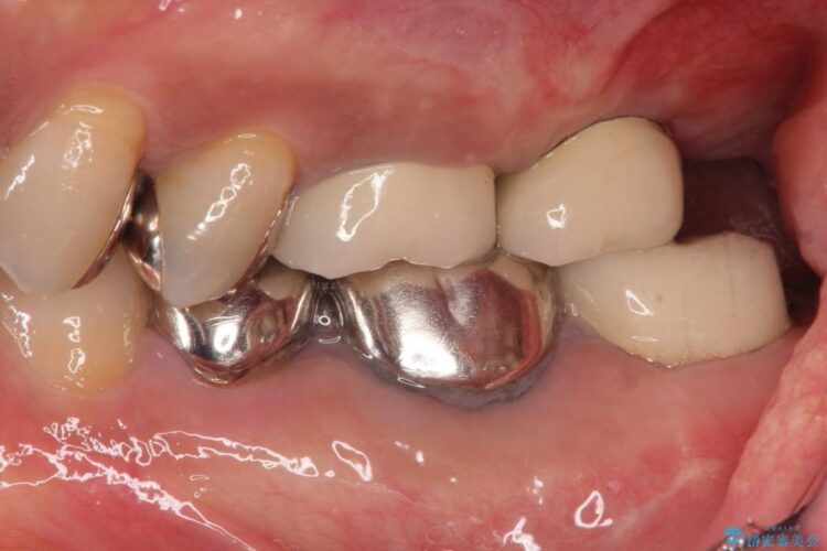 根管治療とインプラント治療で奥歯でしっかりと咬めるように 治療後画像