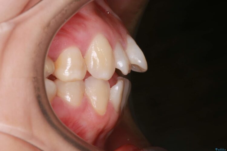 歯が前に出てて、口が閉じない　抜歯矯正による口元の改善 治療前画像