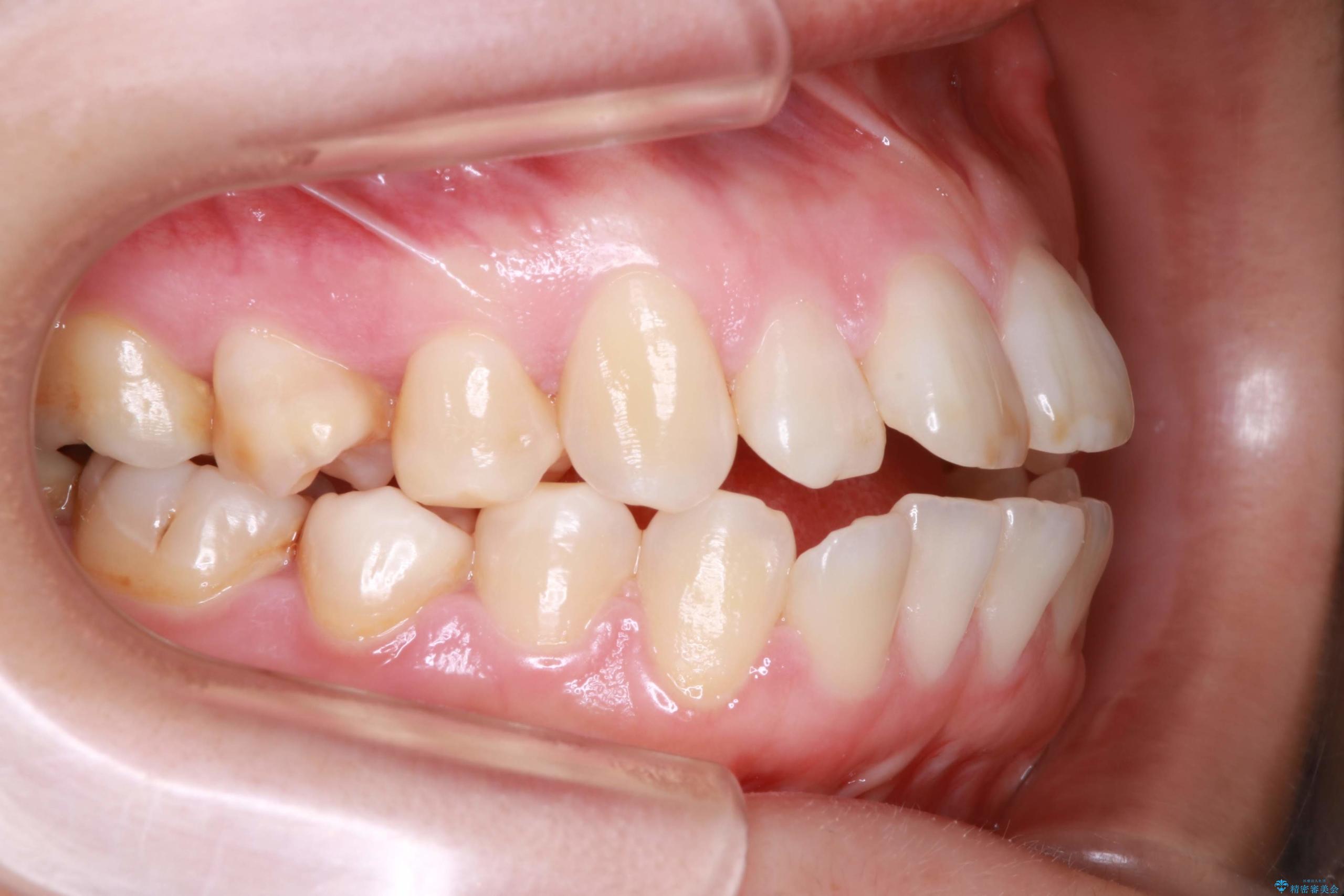 歯が前に出てて、口が閉じない　抜歯矯正による口元の改善 治療前
