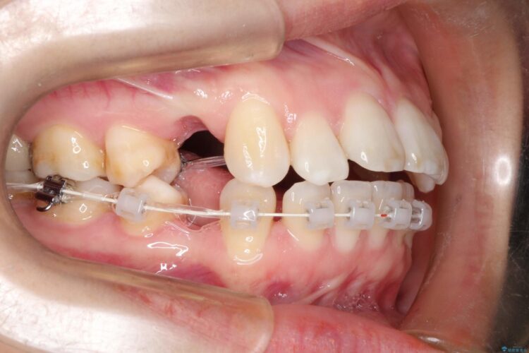 歯が前に出てて、口が閉じない　抜歯矯正による口元の改善 治療途中画像