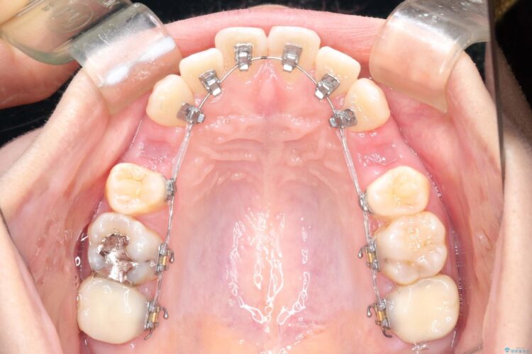 歯が前に出てて、口が閉じない　抜歯矯正による口元の改善 治療途中画像