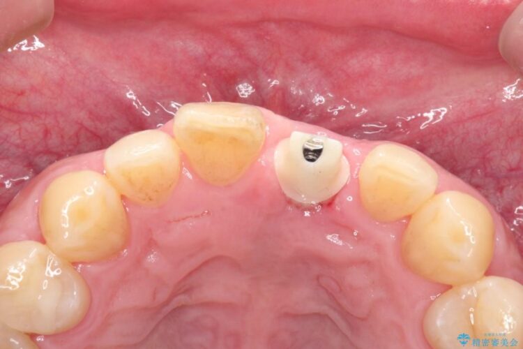 前歯が折れていた　インプラントによる審美的・機能的回復 治療後画像