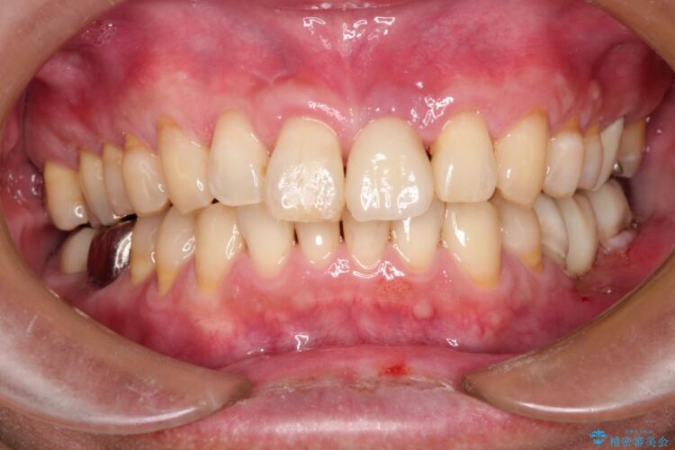 前歯が折れていた　インプラントによる審美的・機能的回復 治療後画像