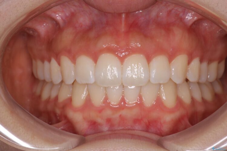 前歯のがたつき　インビザラインで目立たない矯正 治療後画像