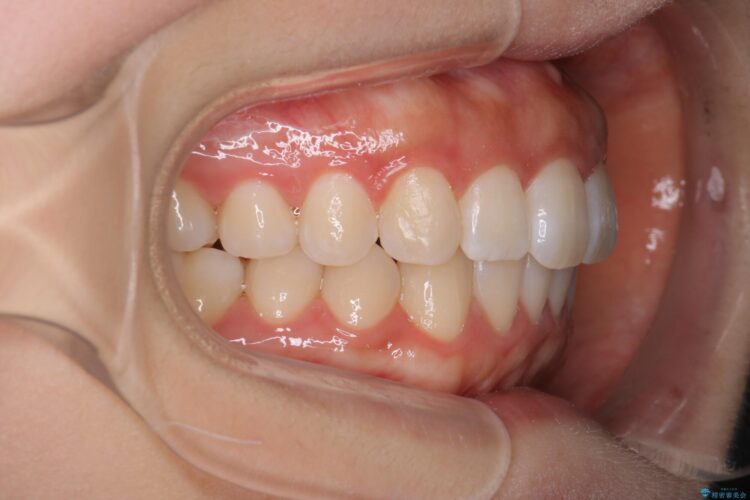 前歯のがたつき　インビザラインで目立たない矯正 治療後画像