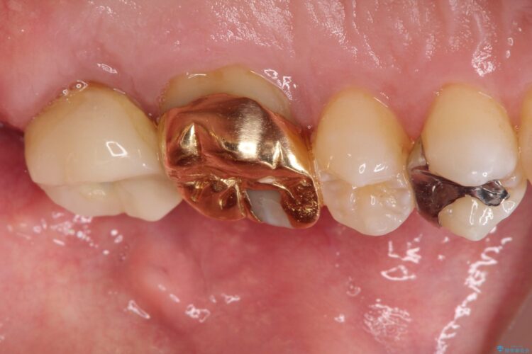 金歯が目立つ　自然な色のオールセラミックへ 治療前画像