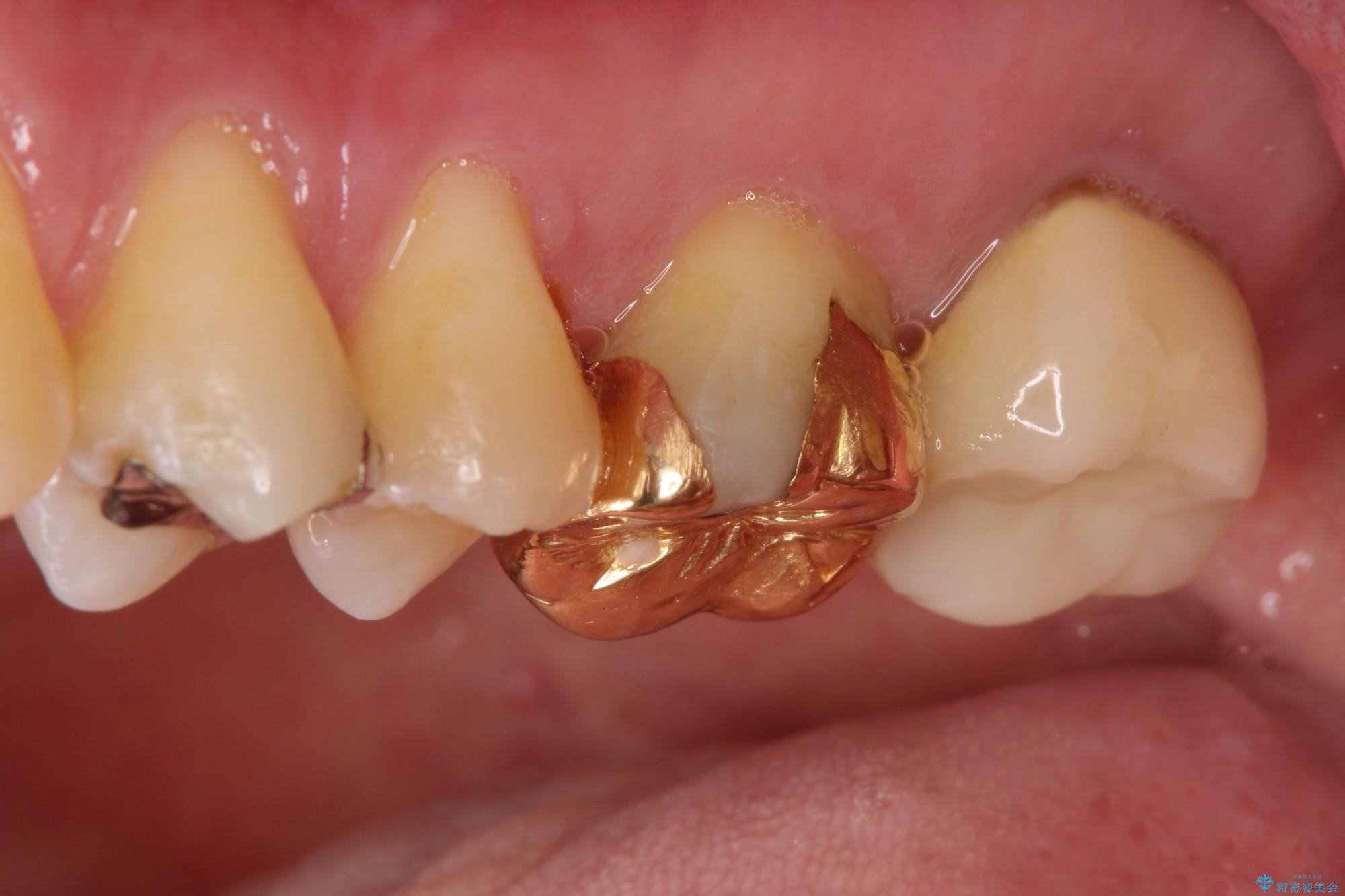 金歯が目立つ 自然な色のオールセラミックへ | 新橋銀座しらゆり歯科