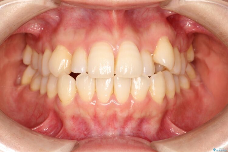 インビザラインによる八重歯の矯正　 ビフォー