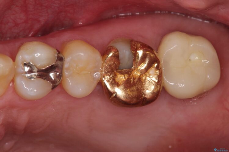 金歯が目立つ　自然な色のオールセラミックへ 治療前画像