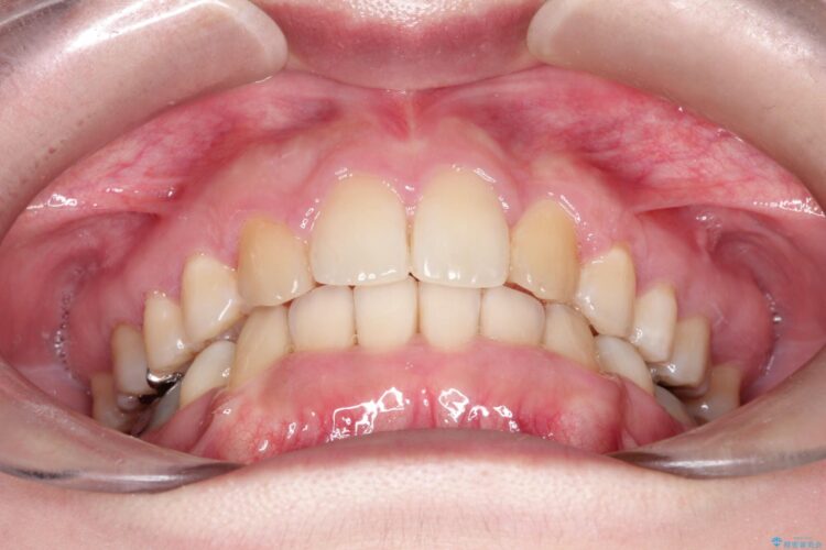 犬歯が変な位置にある　抜歯矯正により正しい位置へ 治療後画像
