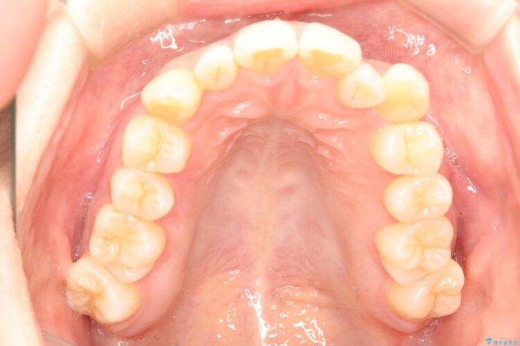 インビザラインによる八重歯の矯正　 治療前画像
