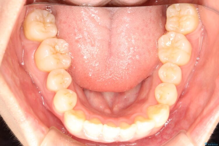 インビザラインによる八重歯の矯正　 治療前画像