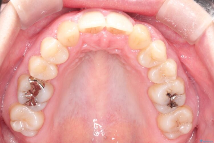 犬歯が変な位置にある　抜歯矯正により正しい位置へ 治療後画像
