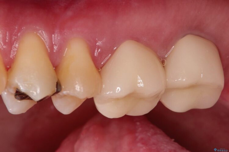 金歯が目立つ　自然な色のオールセラミックへ 治療後画像