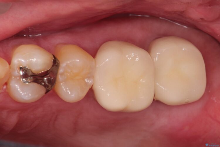 金歯が目立つ　自然な色のオールセラミックへ 治療後画像