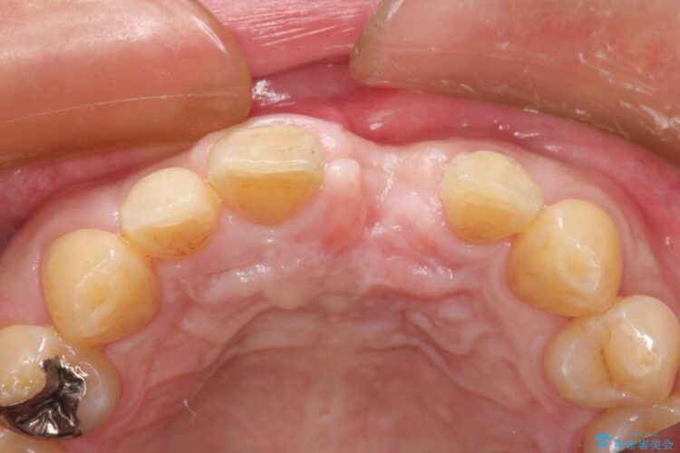 前歯が折れていた　インプラントによる審美的・機能的回復 治療途中画像