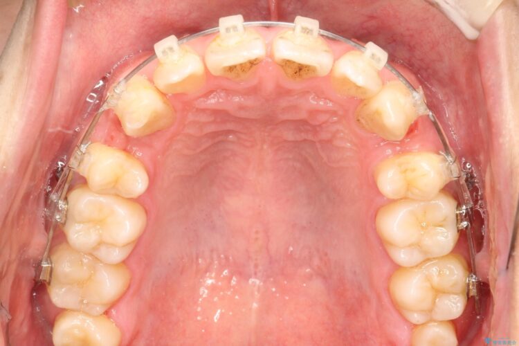 前歯のガタガタをきれいにしたい　ワイヤーによる抜歯矯正で整った歯並びへ 治療途中画像