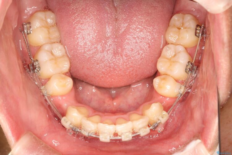 前歯のガタガタをきれいにしたい　ワイヤーによる抜歯矯正で整った歯並びへ 治療途中画像