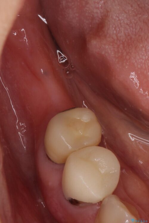 失った奥歯　インプラントブリッジで咬合回復 治療前画像