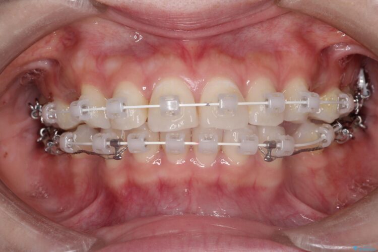 口が閉じにくい　口ゴボの抜歯矯正による改善 治療途中画像