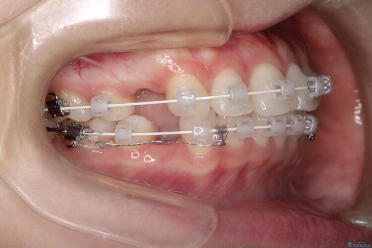 口が閉じにくい　口ゴボの抜歯矯正による改善 治療途中画像