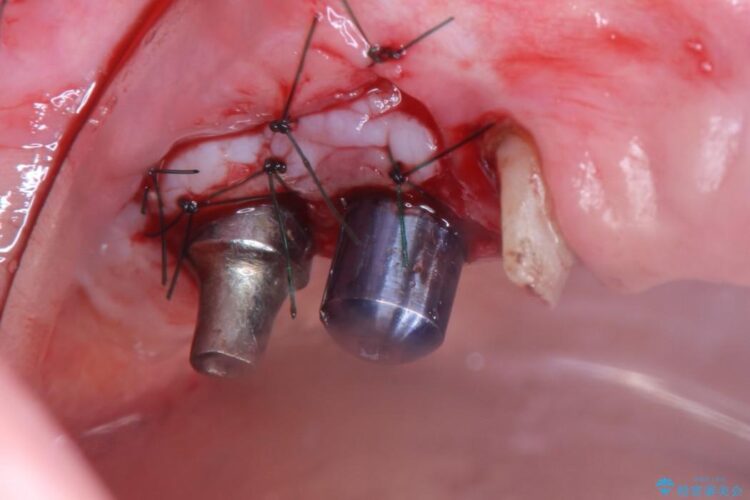 奥歯で咬むことができない　インプラントとセラミックによる咬み合わせの回復 治療途中画像