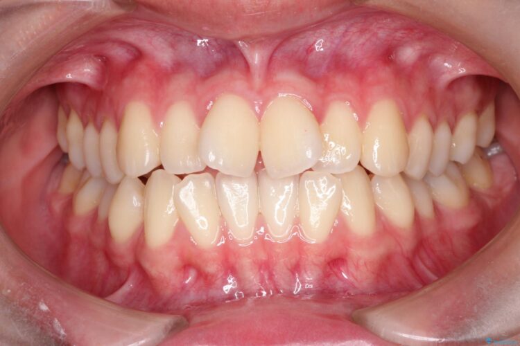 インビザラインによる非抜歯矯正　ガタガタな歯並びを整った歯並びへ ビフォー