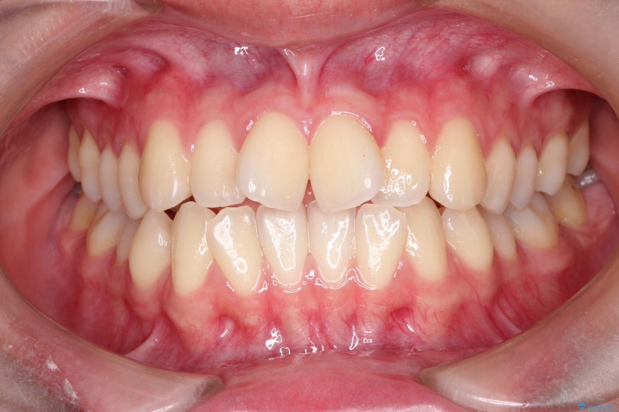 インビザラインによる非抜歯矯正　ガタガタな歯並びを整った歯並びへ 治療前