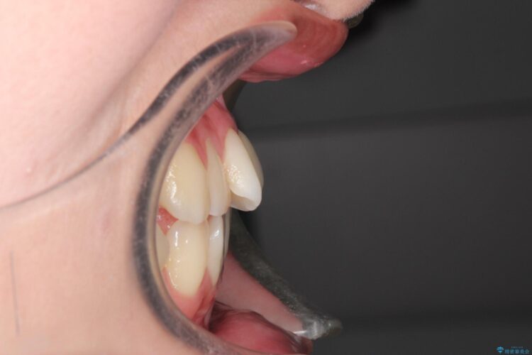 インビザラインによる非抜歯矯正　ガタガタな歯並びを整った歯並びへ 治療前画像